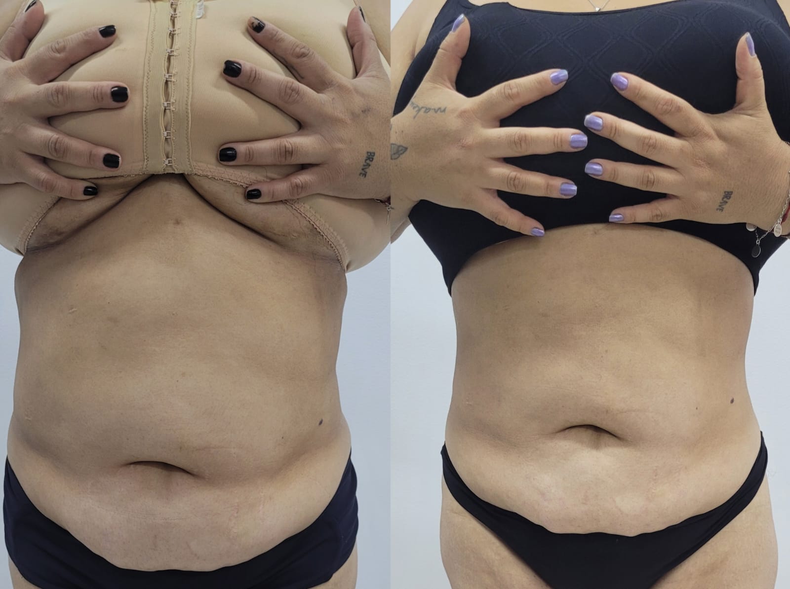 Resultado de procedimento estético - Clínica Lamurie