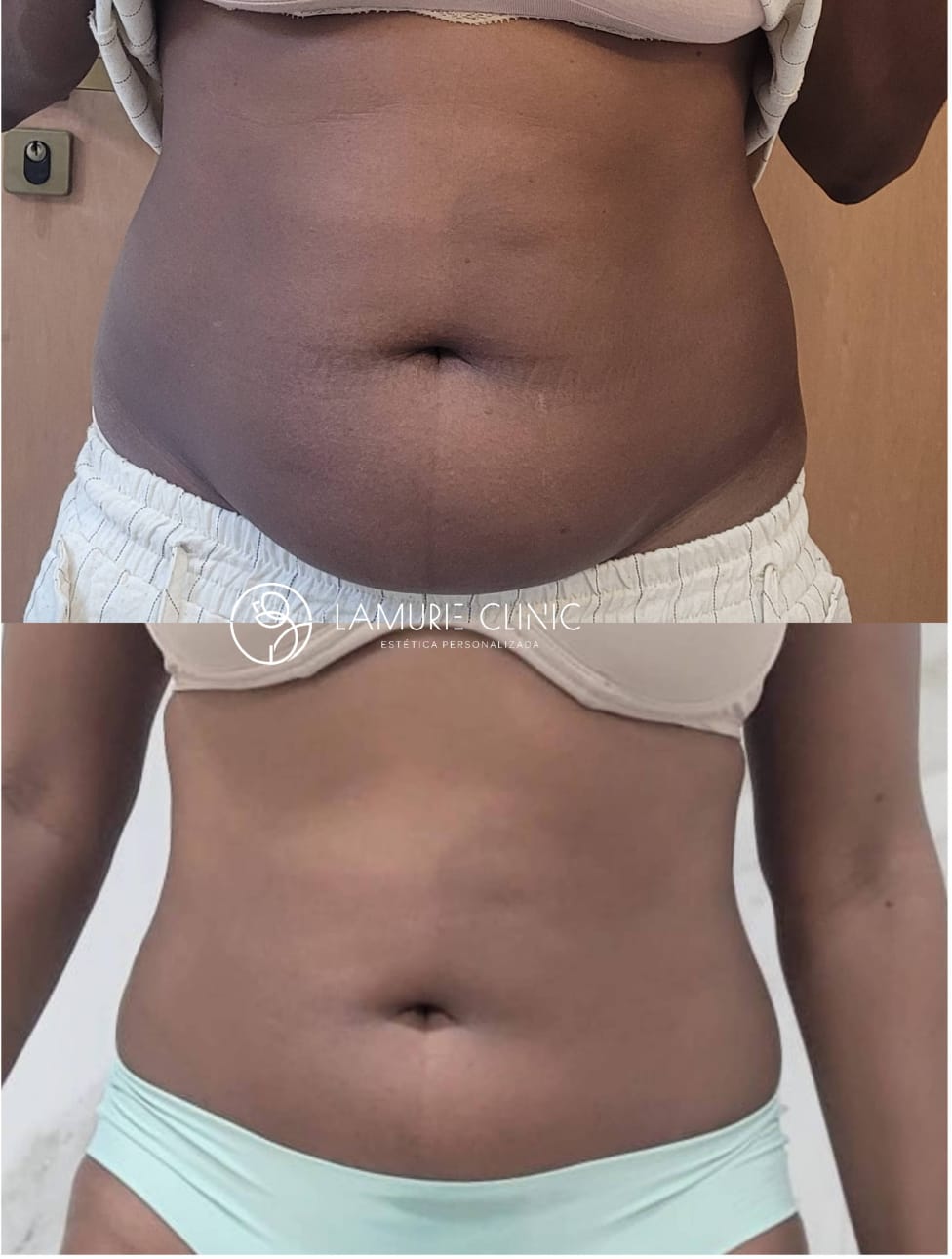 Resultado de procedimento estético - Clínica Lamurie